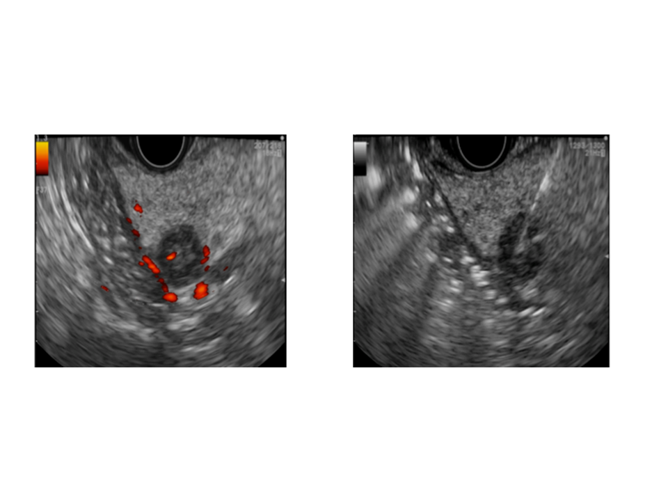 Insulinome radiofréquence Beaujon